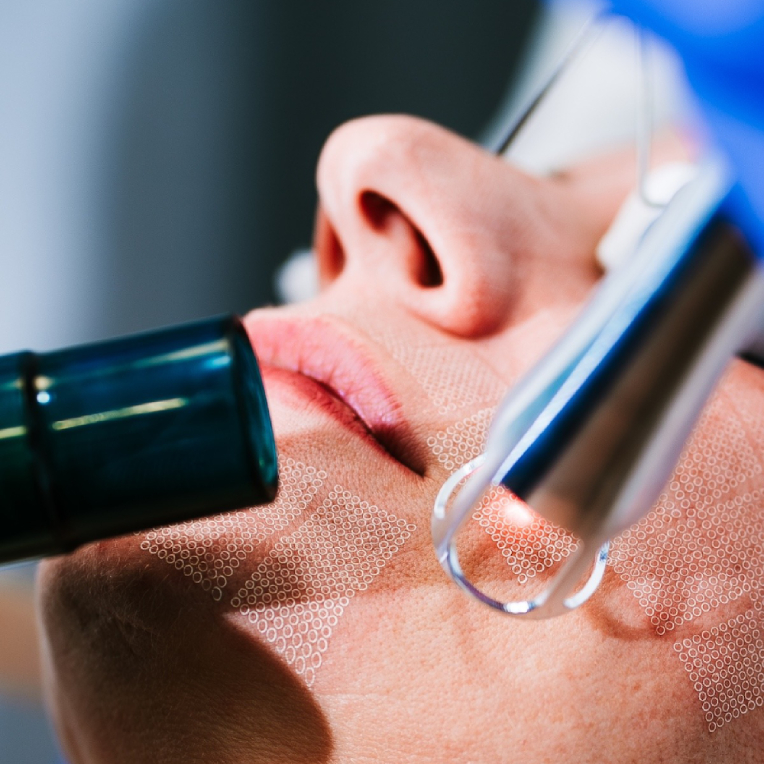 Probala sam revolucionarni UltraClear laser koji briše desetljeća i o kojem svi pričaju