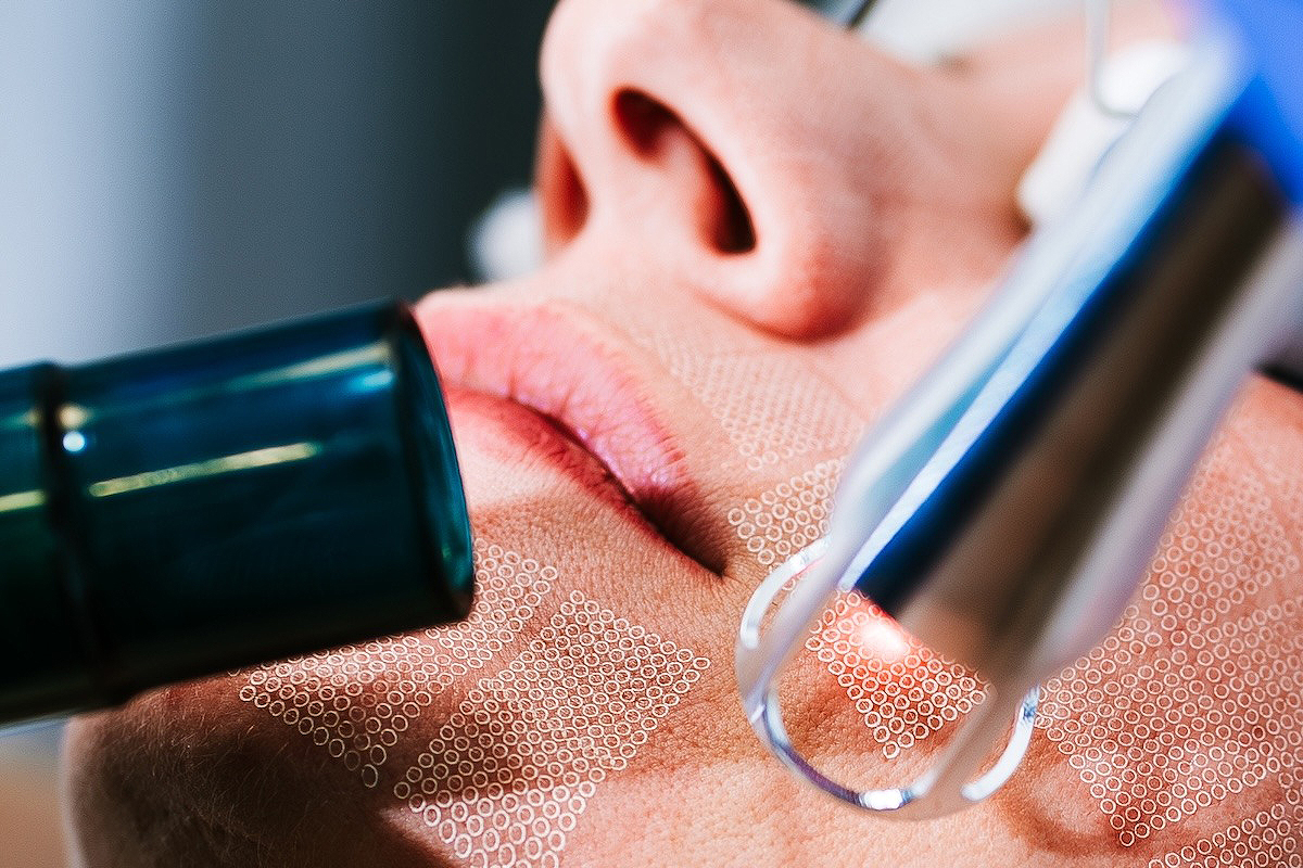 Probala sam revolucionarni UltraClear laser koji briše desetljeća i o kojem svi pričaju