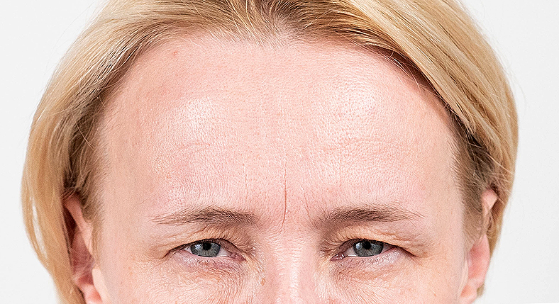 Injekcije za bore, Botox, sl. 1 - poslije