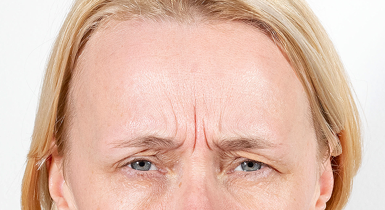 Injekcije za bore, Botox, sl. 1 - prije