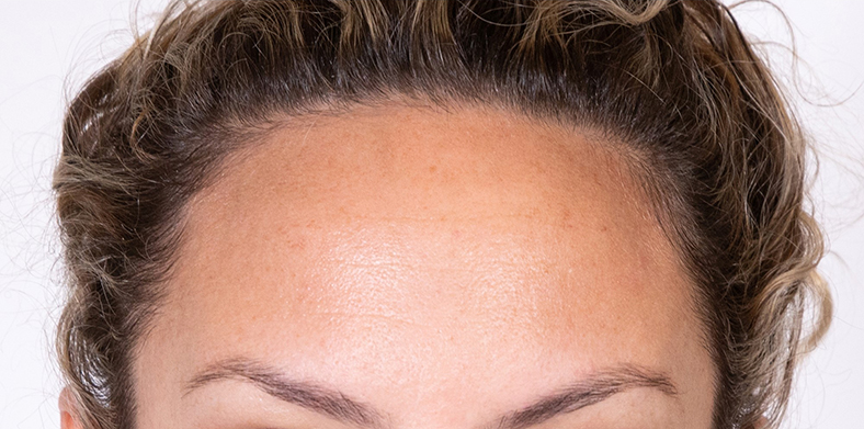 Injekcije za bore, Botox, 2021, sl. 1 - poslije