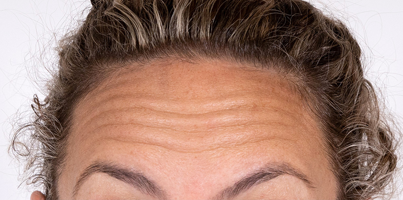 Injekcije za bore, Botox, 2021, sl. 1 - prije