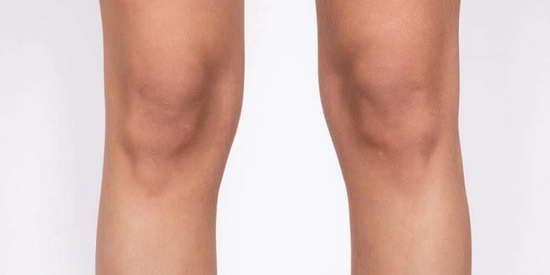 CoolSculpting oblikovanje tijela, noge - poslije