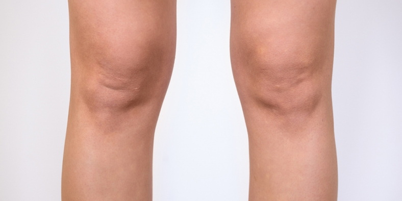 CoolSculpting oblikovanje tijela, noge - prije