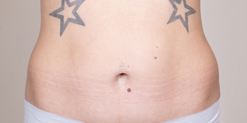 CoolSculpting oblikovanje tijela, Ella sl. 1 - prije