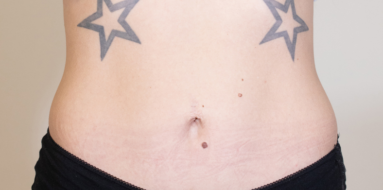 CoolSculpting oblikovanje tijela, Ella sl. 1 - poslije