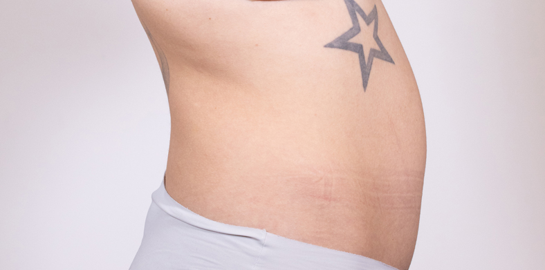 CoolSculpting oblikovanje tijela, Ella sl. 2 - prije