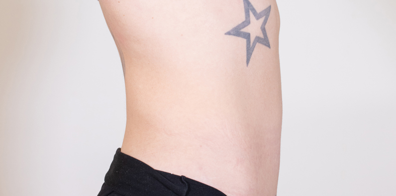 CoolSculpting oblikovanje tijela, Ella sl. 2 - poslije