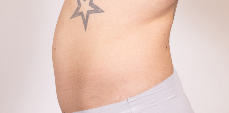 CoolSculpting oblikovanje tijela, Ella sl. 4 - prije