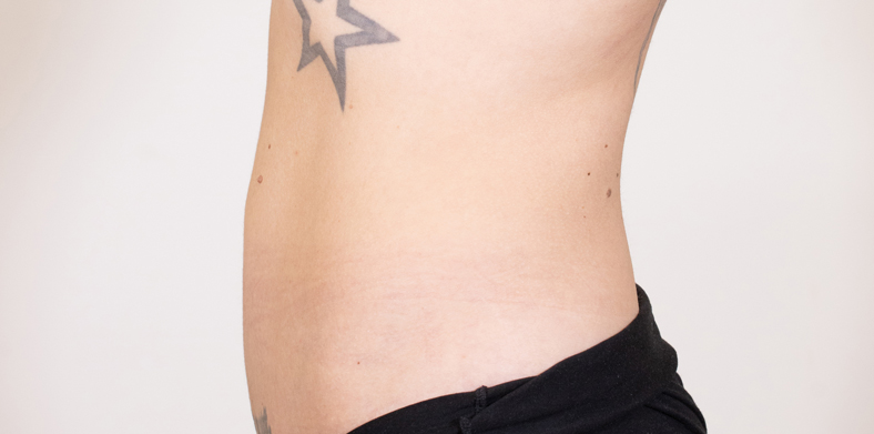 CoolSculpting oblikovanje tijela, Ella sl. 4 - poslije