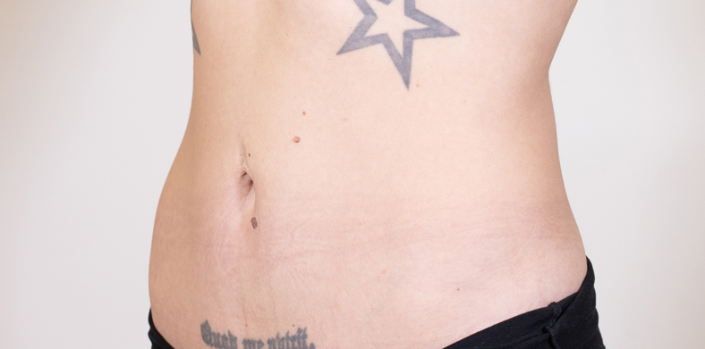 CoolSculpting oblikovanje tijela, Ella sl. 5 - poslije