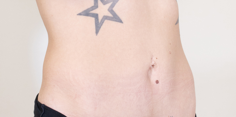 CoolSculpting oblikovanje tijela, Ella sl. 6 - poslije