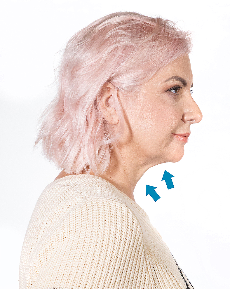 CoolSculpting oblikovanje tijela, sl. 1 - poslije