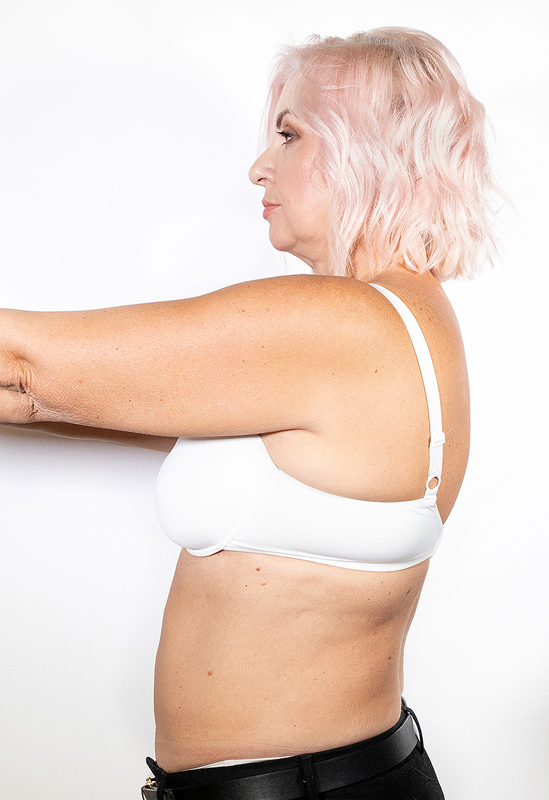 CoolSculpting oblikovanje tijela, sl. 3 - poslije