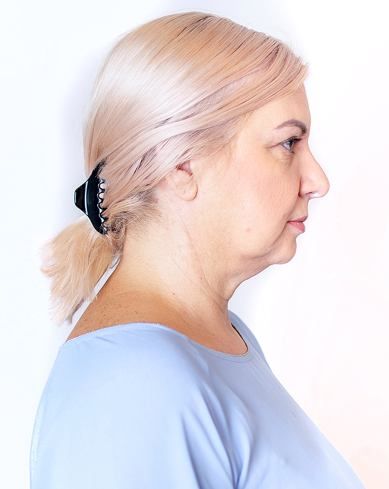 CoolSculpting oblikovanje tijela, sl. 1 - prije