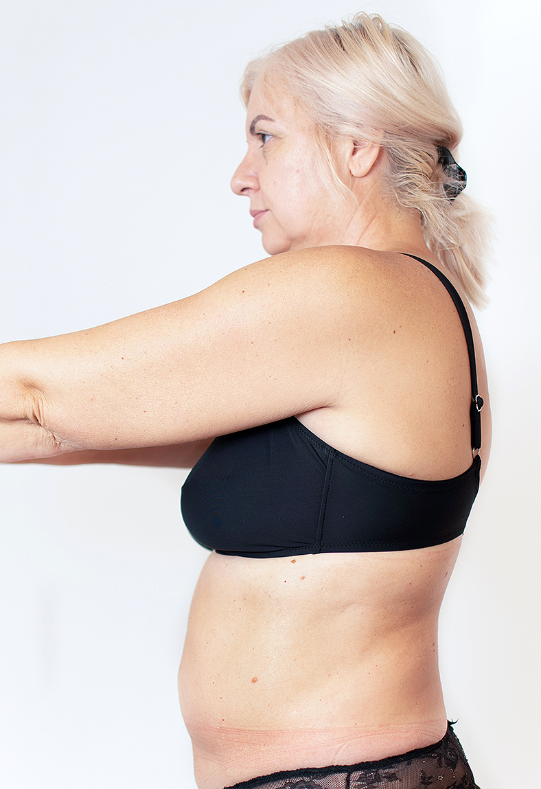 CoolSculpting oblikovanje tijela, sl. 3 - prije