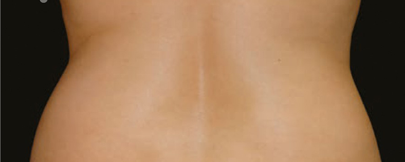 CoolSculpting sl. 1, poslije