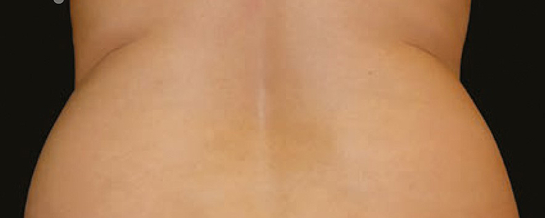 CoolSculpting sl. 1, prije