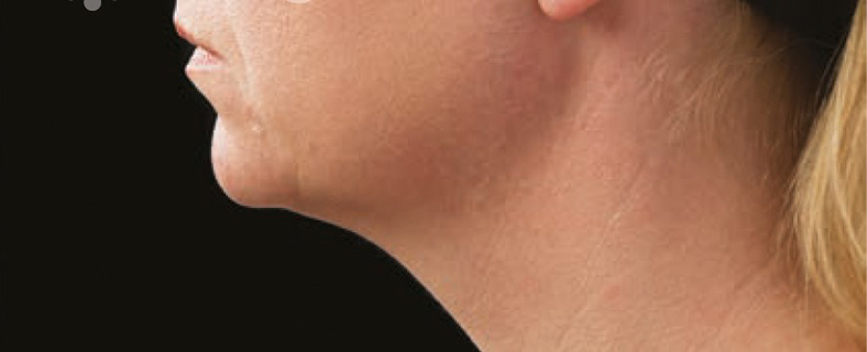 CoolSculpting sl. 2, poslije