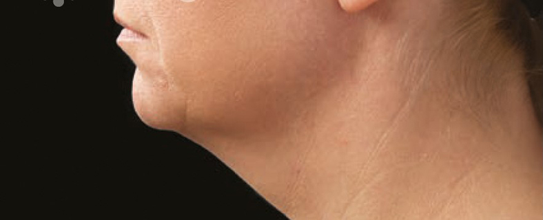 CoolSculpting sl. 2, prije