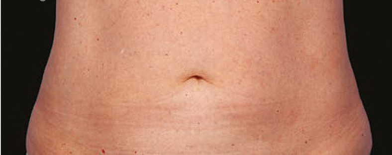 CoolSculpting sl. 3, poslije