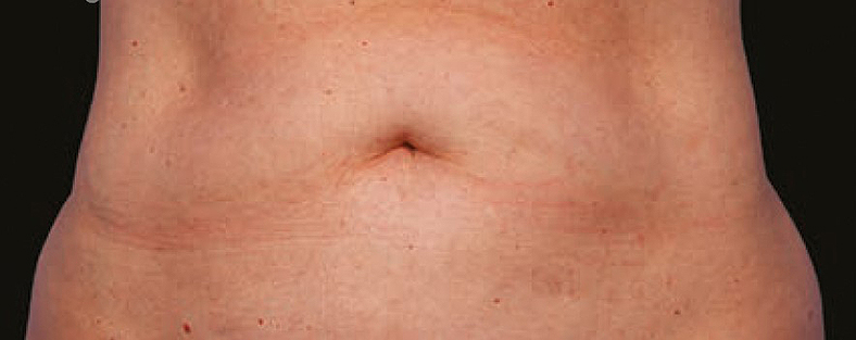 CoolSculpting sl. 3, prije