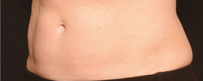 CoolSculpting sl. 6, poslije