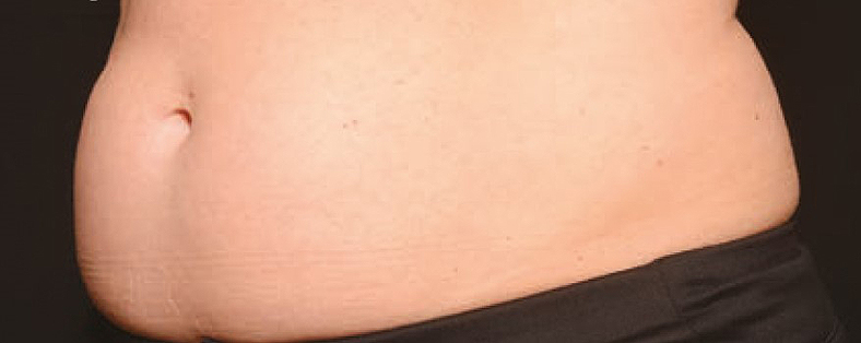 CoolSculpting sl. 6, prije