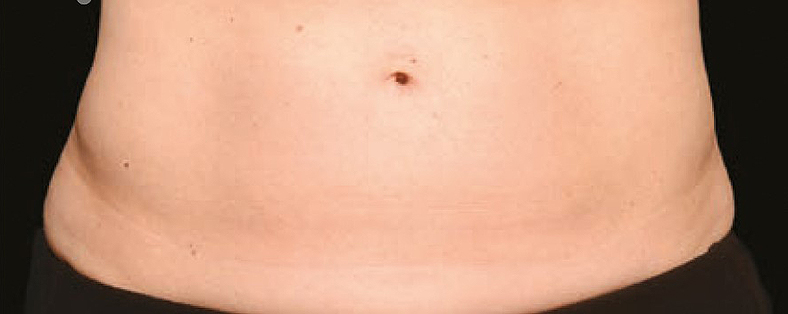 CoolSculpting sl. 5, poslije