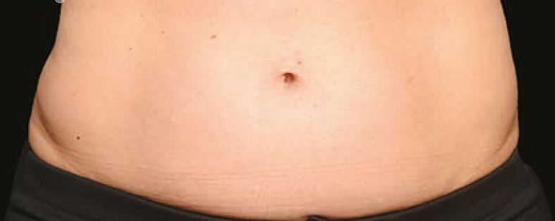CoolSculpting sl. 5, prije