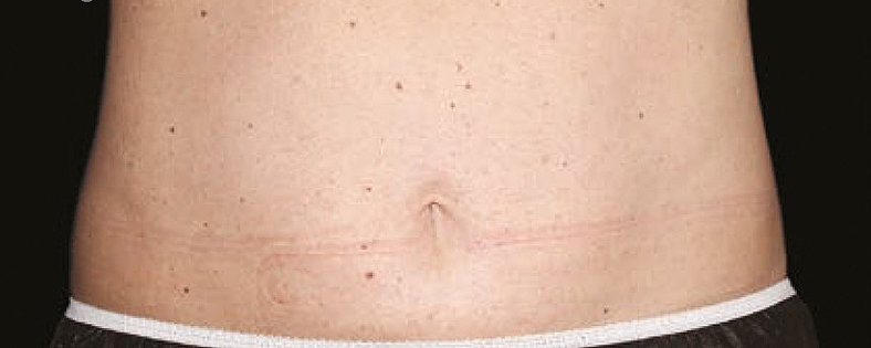 CoolSculpting sl. 4, poslije