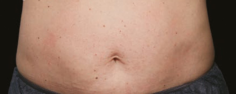 CoolSculpting sl. 4, prije