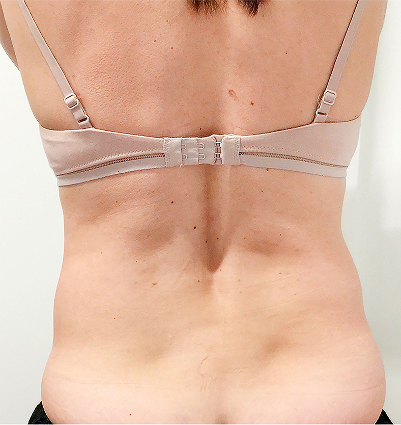 CoolSculpting oblikovanje tijela, sl. 1 - prije