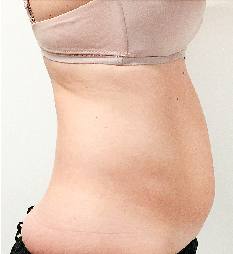 CoolSculpting oblikovanje tijela, sl. 2 - prije