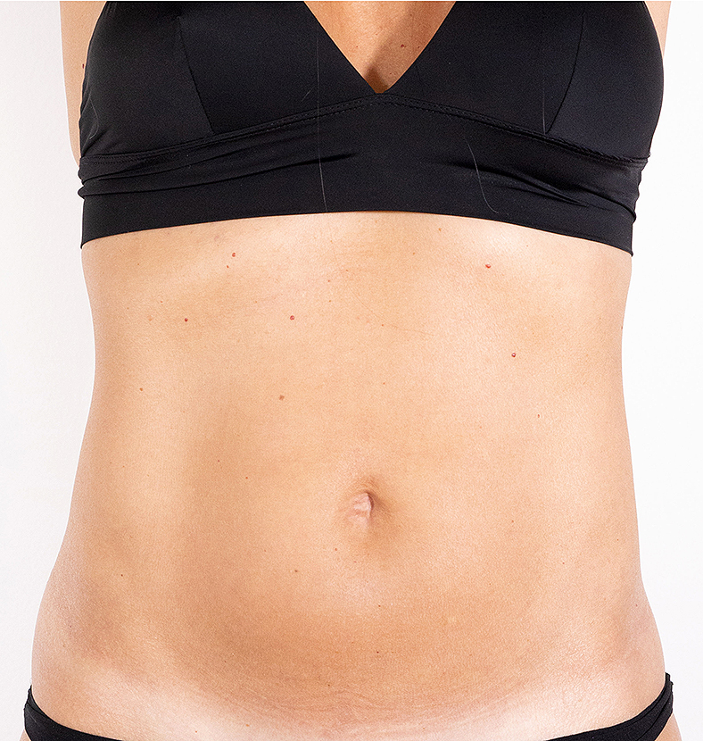 CoolSculpting oblikovanje tijela, sl. 3 - poslije