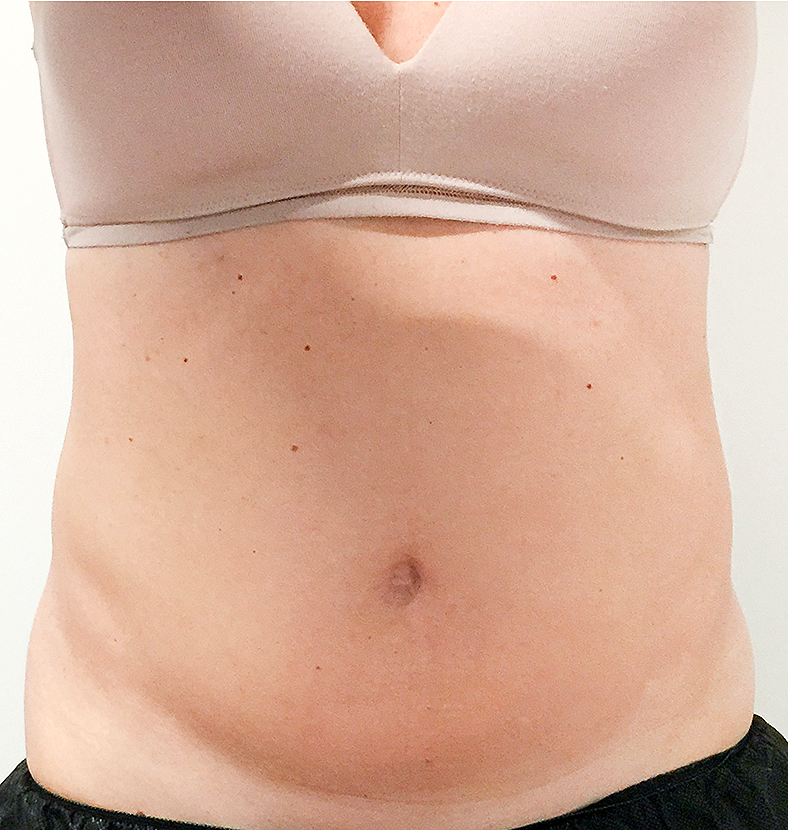 CoolSculpting oblikovanje tijela, sl. 3 - prije