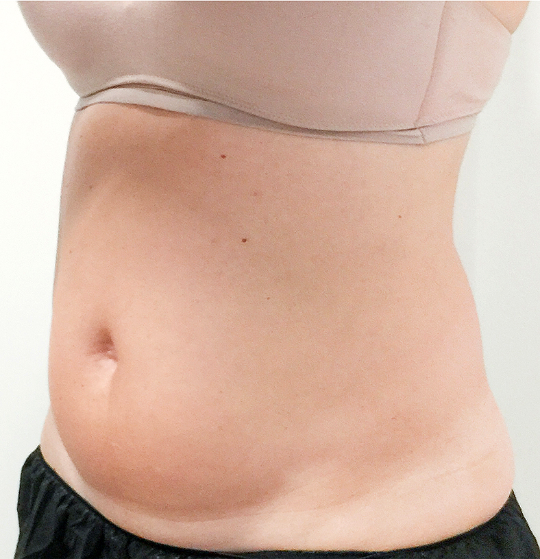 CoolSculpting oblikovanje tijela, sl. 4 - prije