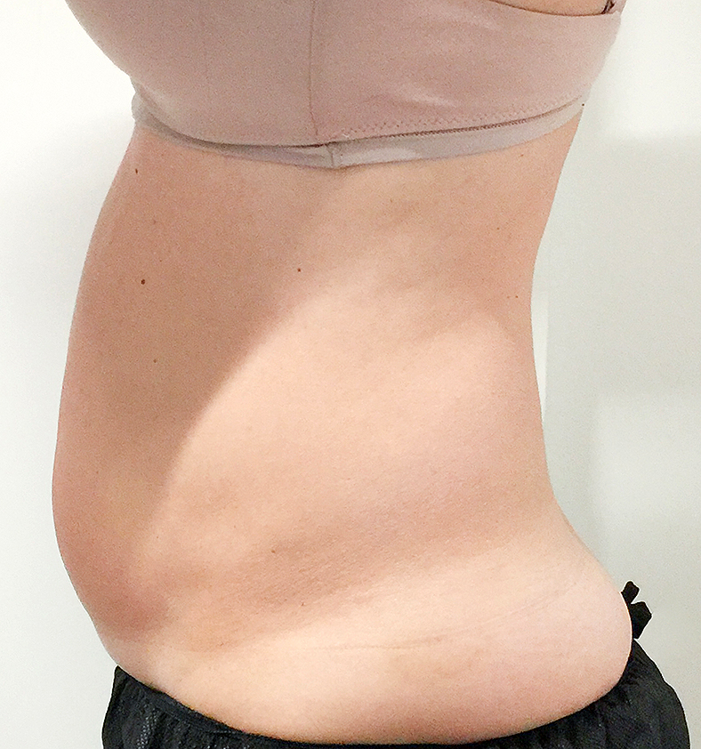 CoolSculpting oblikovanje tijela, sl. 5 - prije