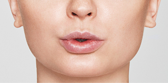 Dermalni fileri - poslije 2