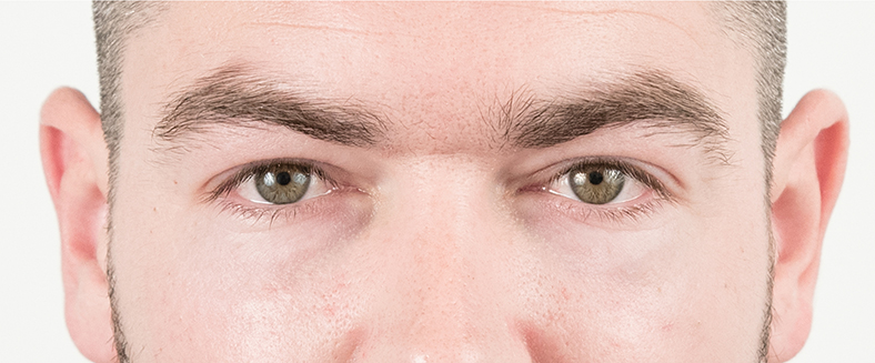 Dermalni fileri - poslije