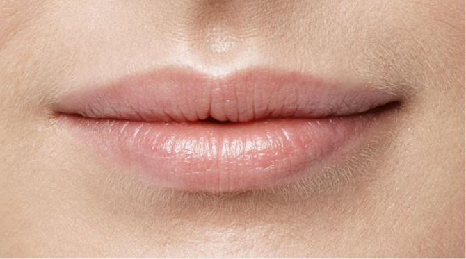 Dermalni fileri - prije 1