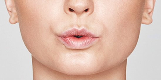 Dermalni fileri - prije 2