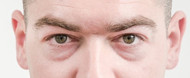 Dermalni fileri - prije