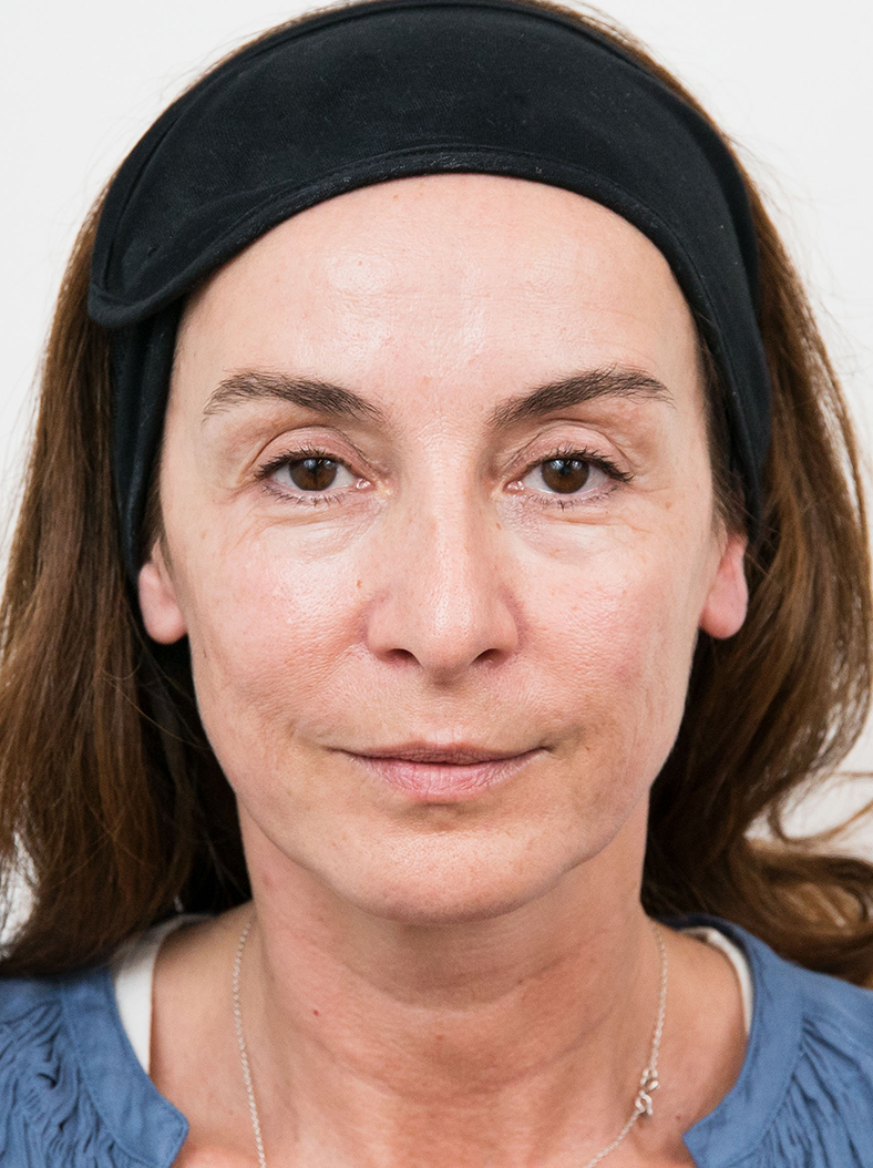 Dermalni fileri, prije