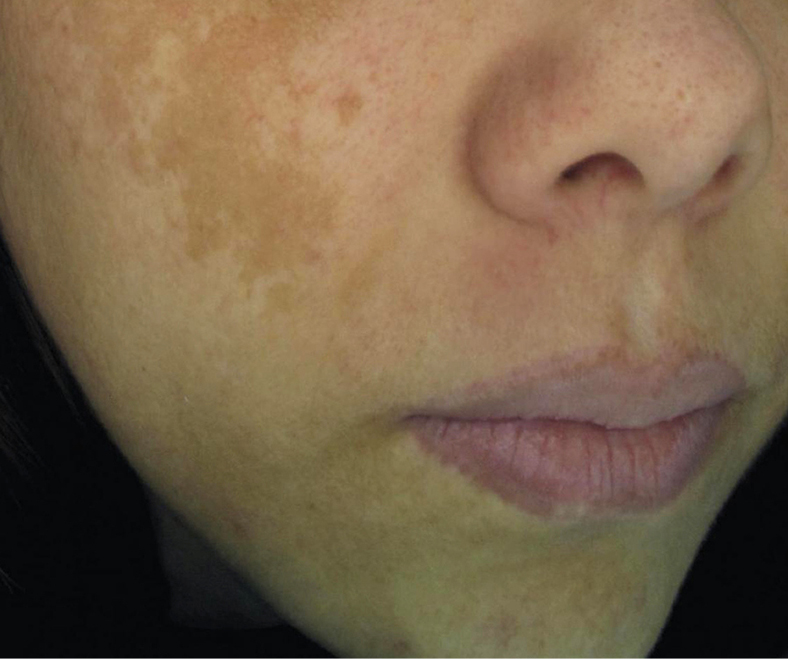 Dermamelan tretman (Melazma), prije