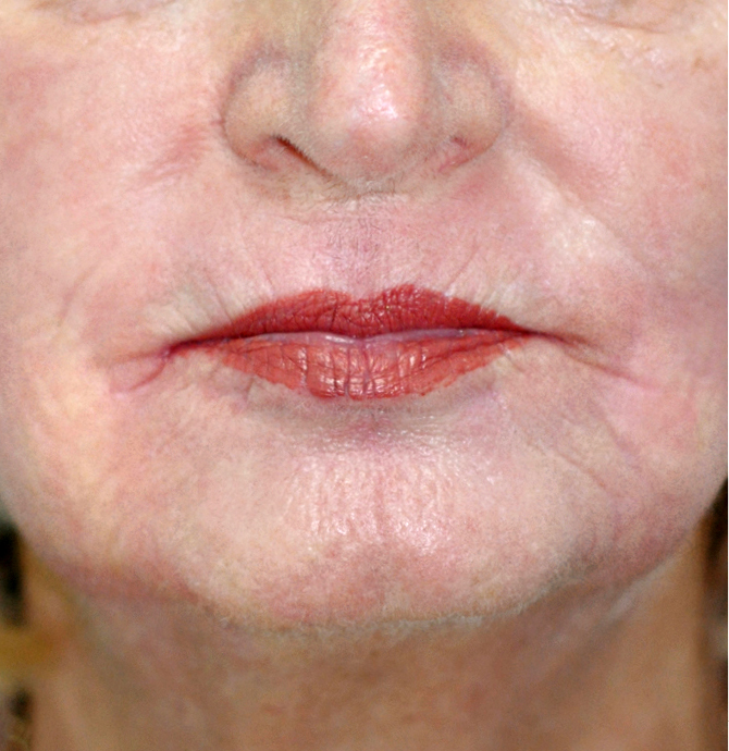 Frakcijski laser - poslije 1