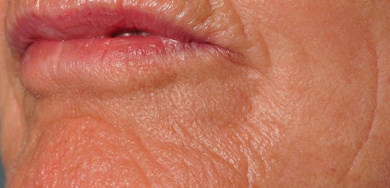 Frakcijski laser - poslije 2