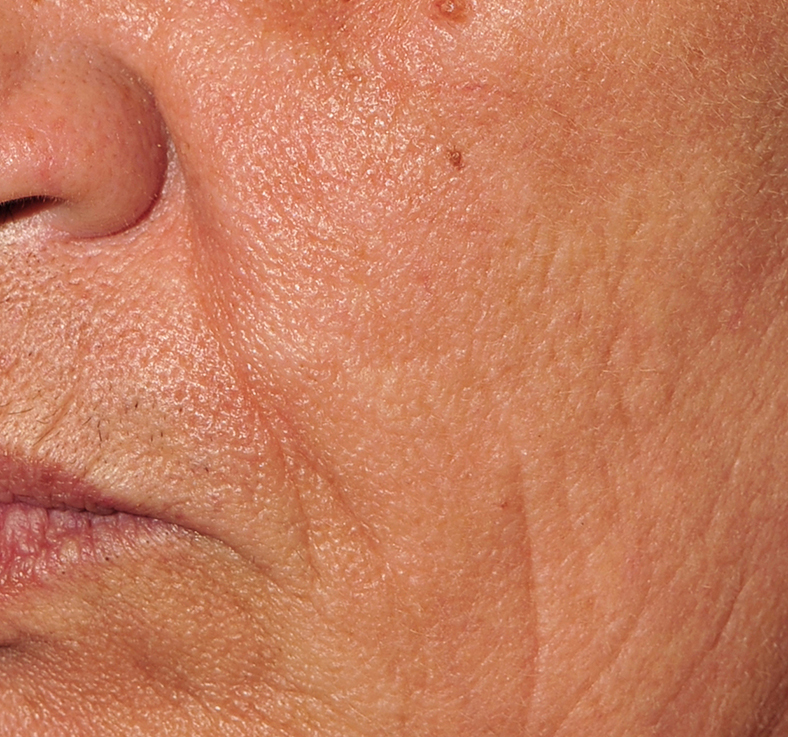 Frakcijski laser - poslije 3