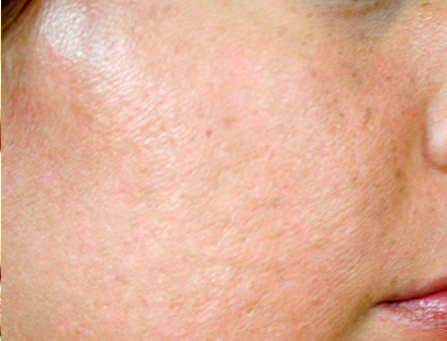 Frakcijski laser - poslije 4