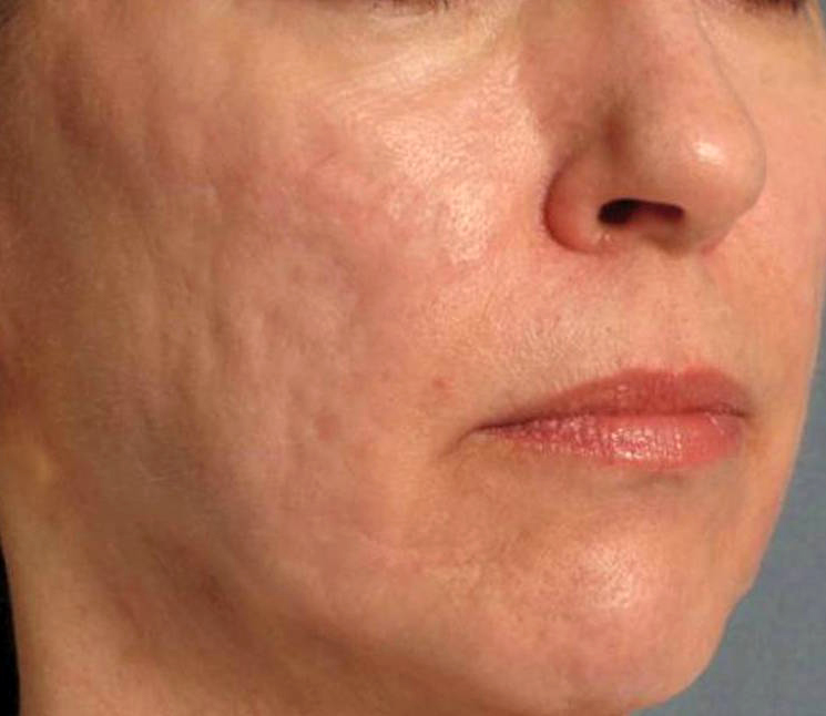 Frakcijski laser - poslije 5